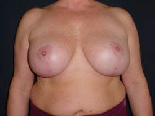 Breast Augmentation with Lift - Patient 8 - After 1