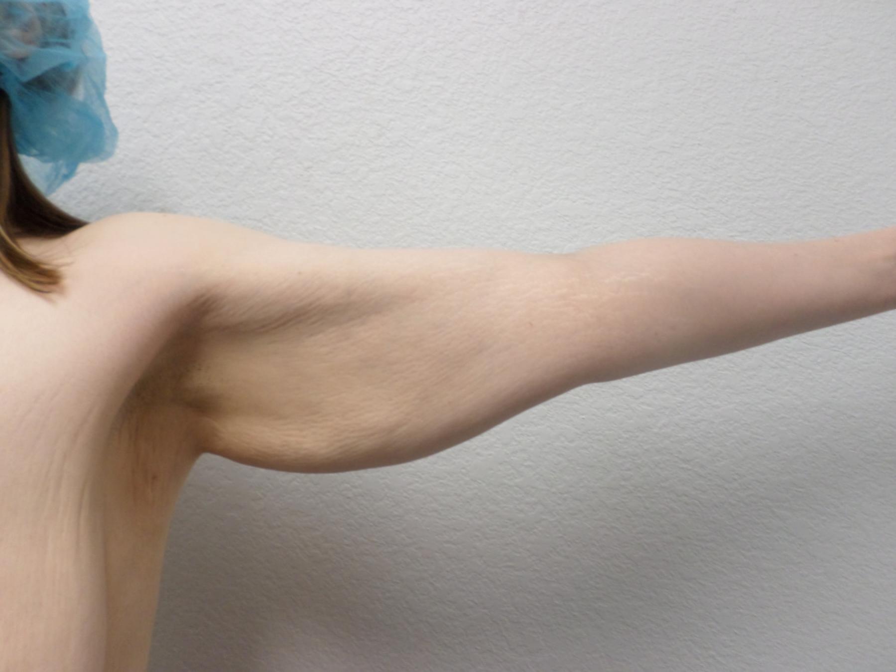 Arm Lift: Patient 8 - Before 