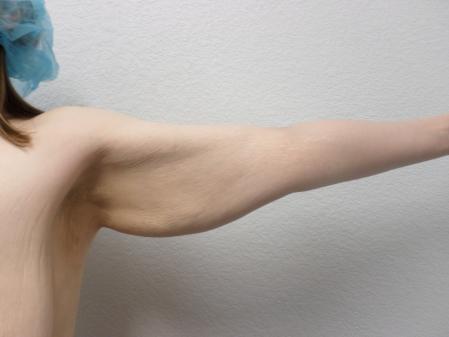 Arm Lift: Patient 5 - Before 