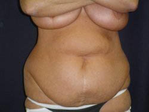 Liposuction - Patient 11 - Before 1