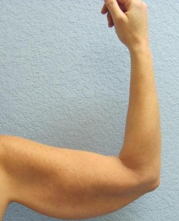 Arm Lift Surgery - Patient 3 - Before Image 7