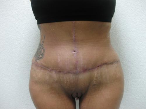 Patient 9 - Cosmetic Surgery After Massive Weight Loss - After 
