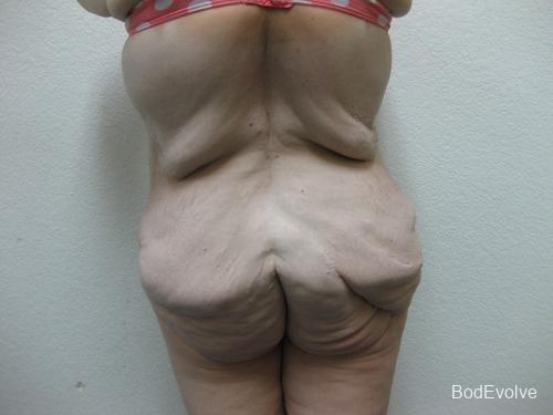 Patient 6 - Cosmetic Surgery After Massive Weight Loss - Before 6