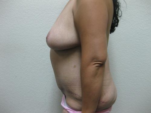 Patient 12 - Cosmetic Surgery After Massive Weight Loss -  After 3