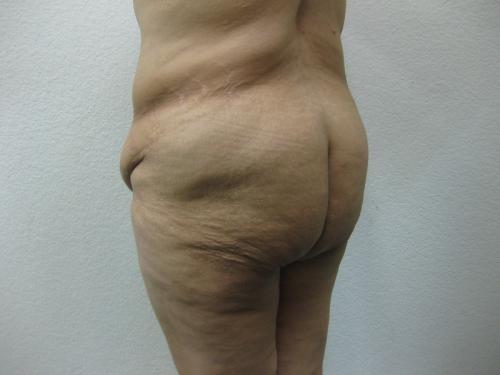 Patient 14 - Cosmetic Surgery After Massive Weight Loss - Before 5