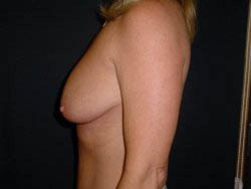 Breast Augmentation - Patient 18 - Before and After 3