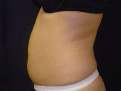 Liposuction - Patient 9 - Before and After 3
