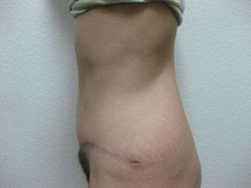 Patient 11 - Cosmetic Surgery After Massive Weight Loss -  After 3