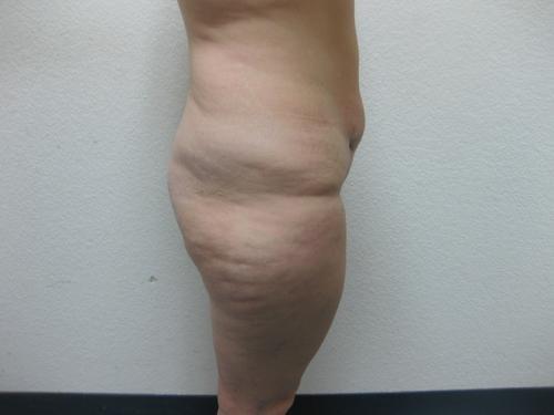 Liposuction - Patient 3 - Before 6