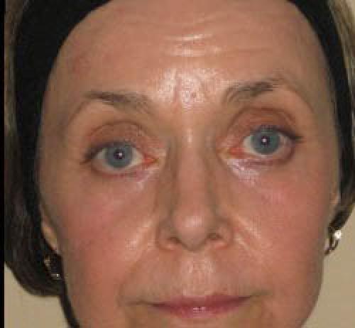 Laser Skin Resurfacing - After 