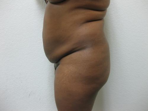 Brazilian Butt Lift - Patient 5 - Before 2