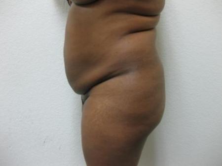 Brazilian Butt Lift - Patient 5 - Before Image 2