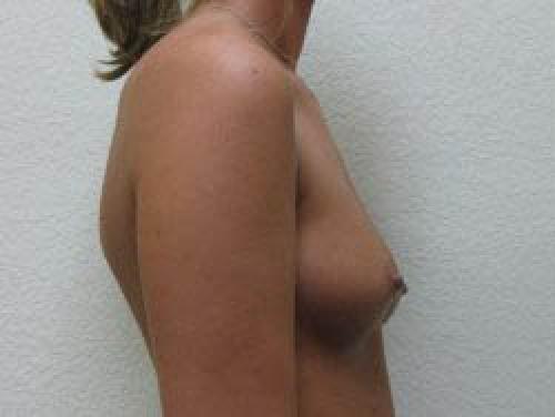Breast Augmentation - Patient 10 - Before and After 3