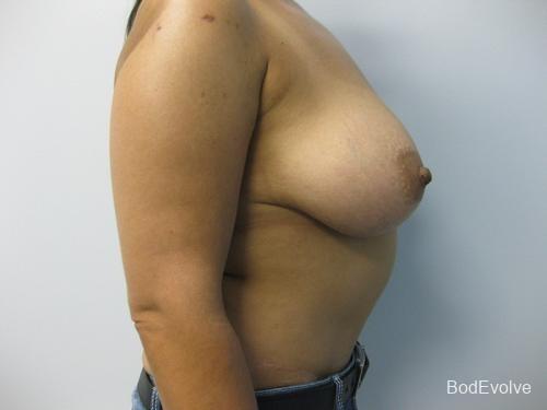 Breast Reduction - Patient 1 - Before 2