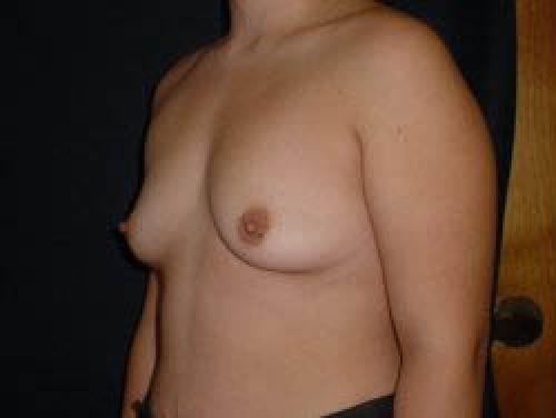 Breast Augmentation - Patient 8 - Before 2