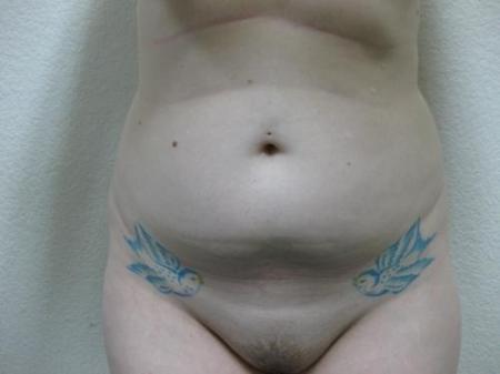 Liposuction - Patient 5 - Before