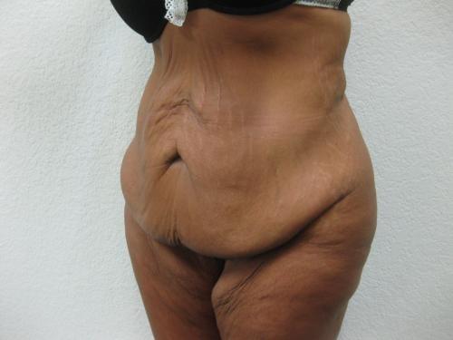 Tummy Tuck - Patient 3 - Before 2