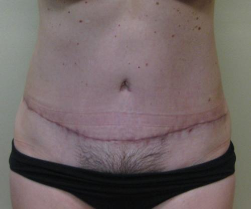 Tummy Tuck - Patient 6 -  After 2
