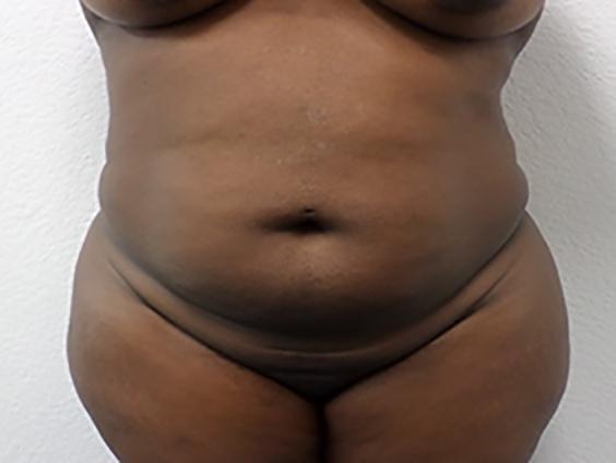 Liposuction: Patient 14 - Before 1