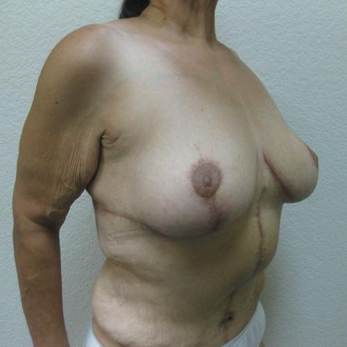 Patient 22 - Cosmetic Surgery After Massive Weight Loss -  After 3