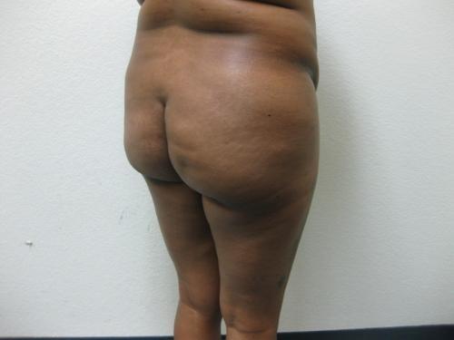 Brazilian Butt Lift - Patient 5 - Before 4
