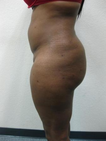 Brazilian Butt Lift - Patient 2 - After Image 1