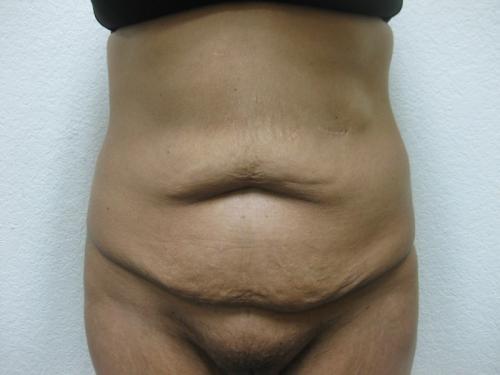 Patient 8 - Cosmetic Surgery After Massive Weight Loss - Before