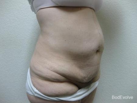 Patient 4 - Cosmetic Surgery After Massive Weight Loss - Before Image 4