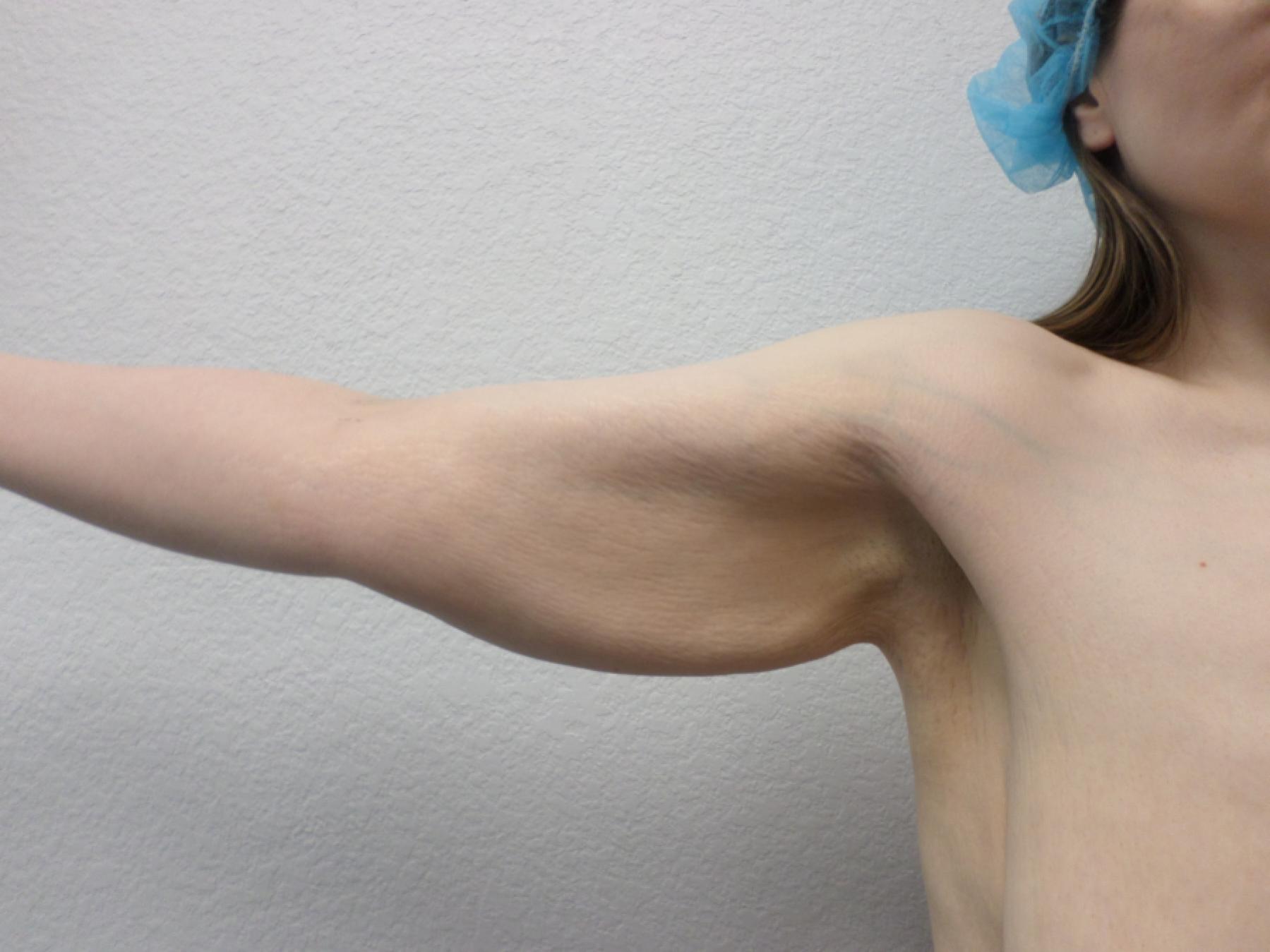 Arm Lift: Patient 8 - Before 3