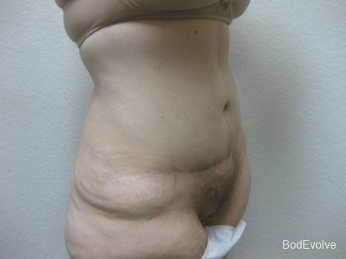 Patient 4 - Cosmetic Surgery After Massive Weight Loss -  After 4
