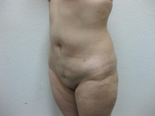 Liposuction - Patient 3 -  After 2