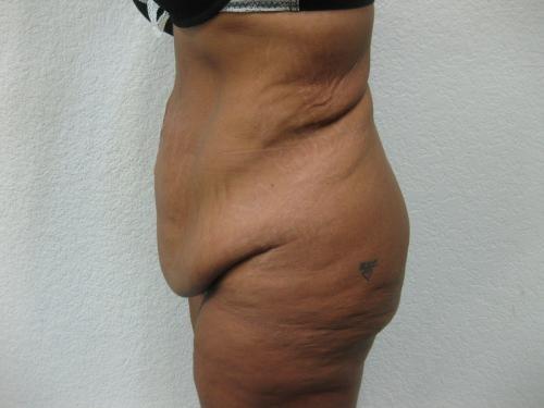 Patient 9 - Cosmetic Surgery After Massive Weight Loss - Before 3