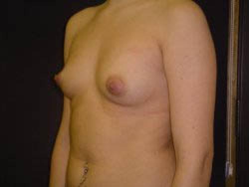 Breast Augmentation - Patient 15 - Before 2