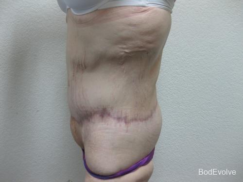 Patient 6 - Cosmetic Surgery After Massive Weight Loss -  After 4