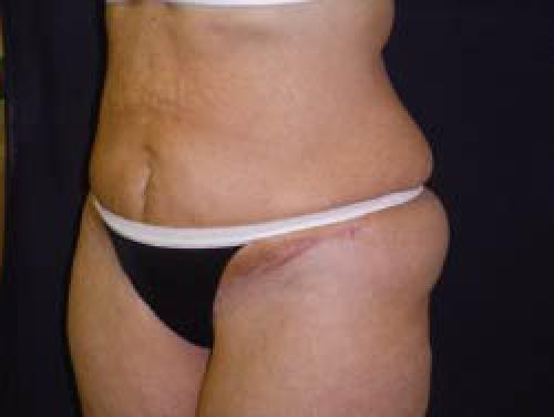 Liposuction - Patient 11 -  After 2