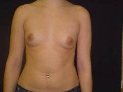 Breast Augmentation - Patient 15 - Before 1