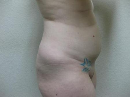 Liposuction - Patient 5 - Before Image 2