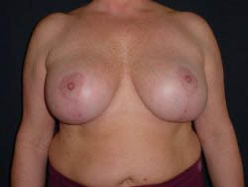 Breast Augmentation with Lift - Patient 6 - After 1