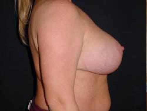 Breast Augmentation with Lift - Patient 8 - After 3