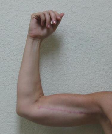 Arm Lift Surgery - Patient 3 - After Image 5