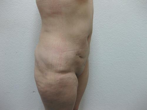 Liposuction - Patient 3 -  After 7