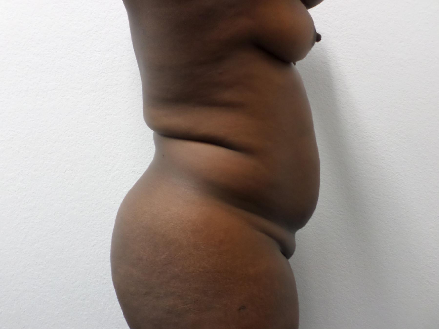 Liposuction: Patient 14 - Before and After 5