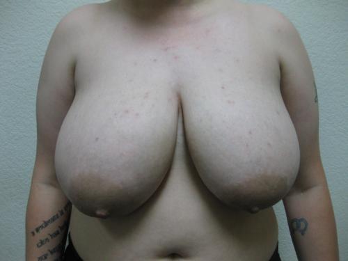 Breast Reduction - Patient 2 - Before 1