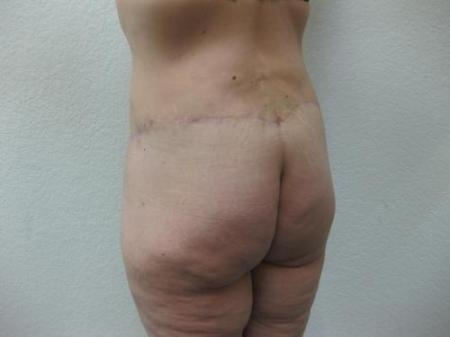 Body Lift - Patient 8 - After Image 5