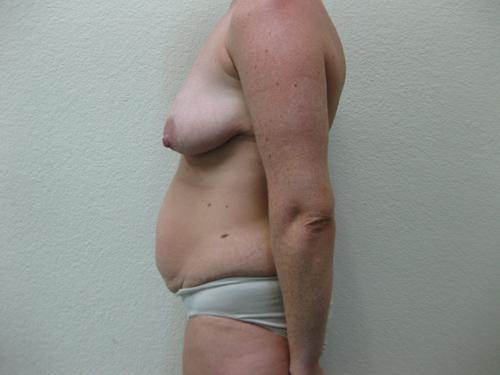 Tummy Tuck - Patient 13 - Before and After 3