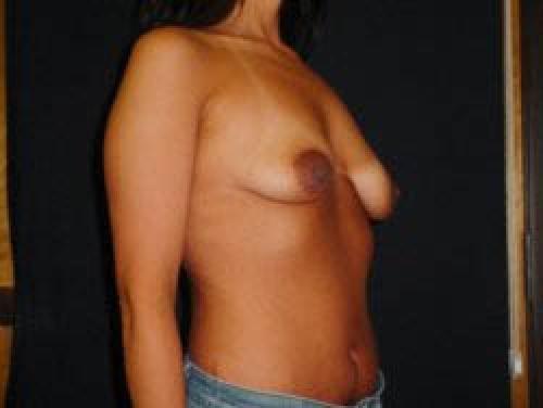 Breast Augmentation with Lift - Patient 4 - Before 2