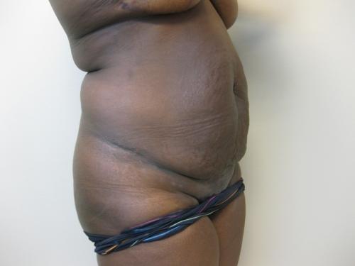 Patient 13 - Cosmetic Surgery After Massive Weight Loss - Before 4