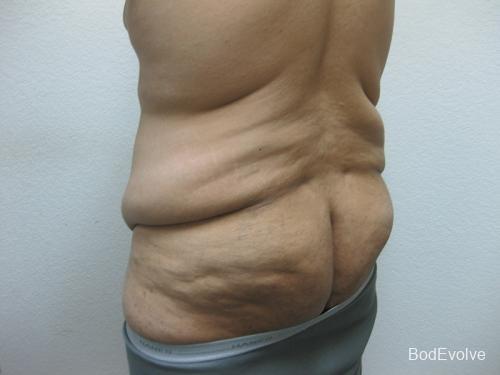 Patient 3 - Cosmetic Surgery After Massive Weight Loss - Before 4