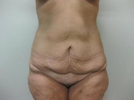Body Lift - Patient 9 - Before