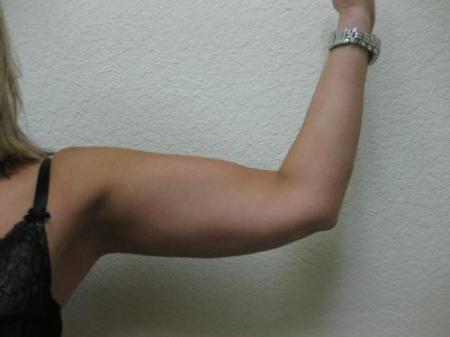 Liposuction - Patient 4 - After Image 1